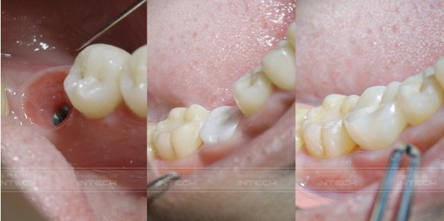 Trồng răng Implant: Giải pháp hoàn hảo cho nụ cười rạng rỡ